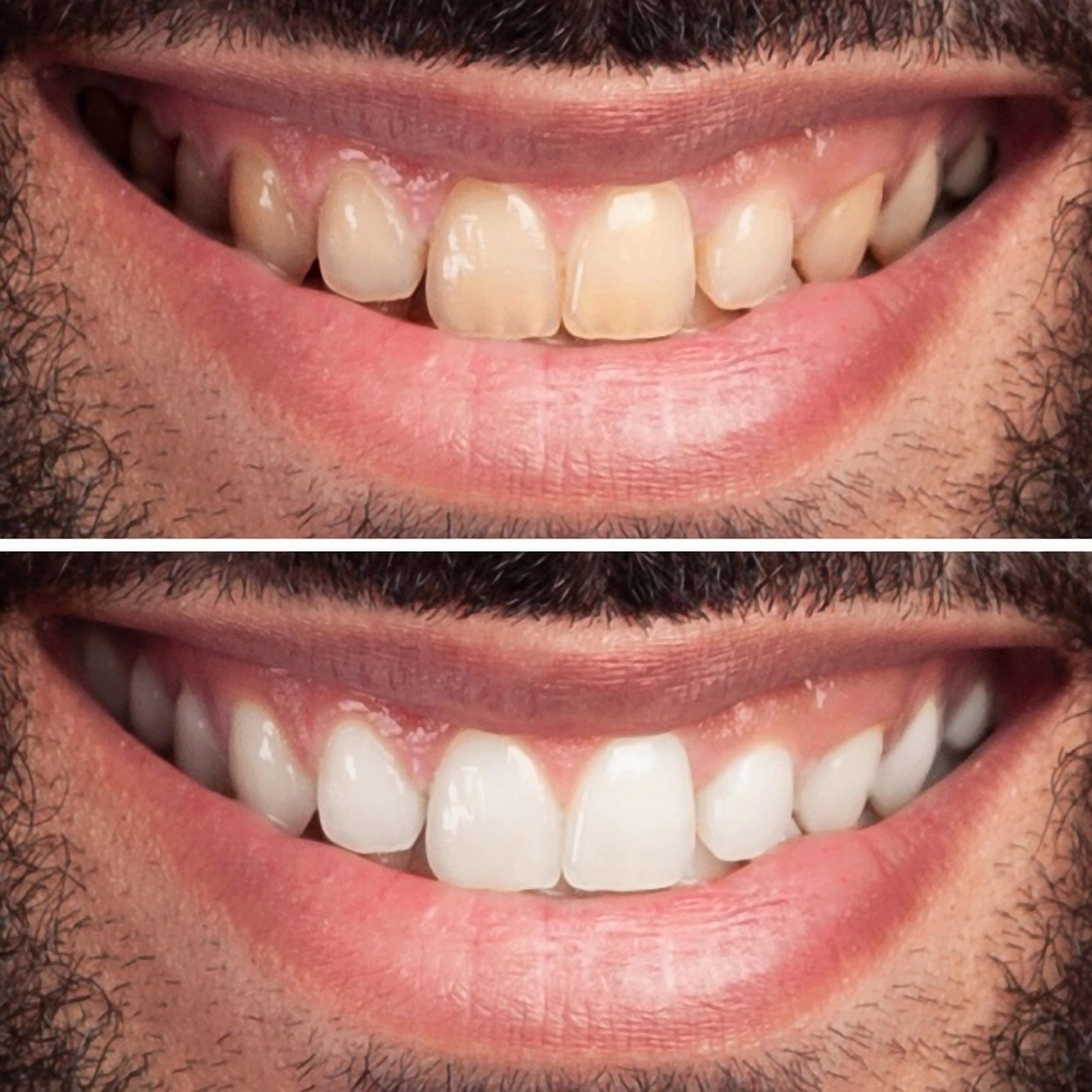 Parkway Clinic - Teeth Whitening - Top Image 2