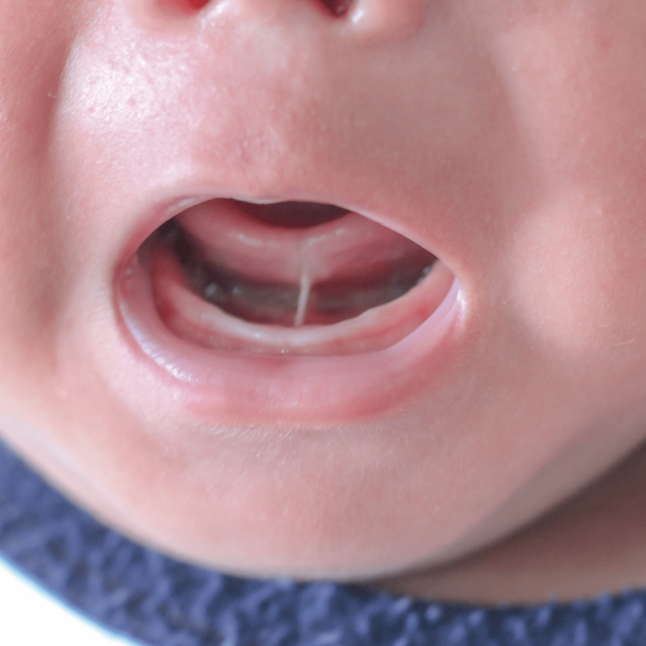 Tongue Tie - Parkway Clinic - Top Image 2-min